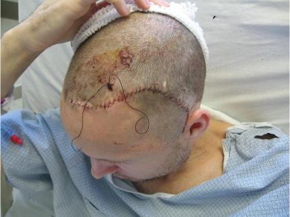 Cancerous tumours in the exposed areas of the head